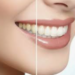 Brighter Smiles with Expert Teeth Whitening Balmain