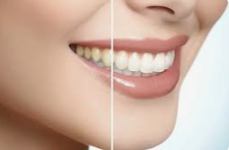 Brighter Smiles with Expert Teeth Whitening Balmain