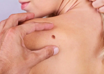 Understanding Skin Cancer Related Lumps and Bumps