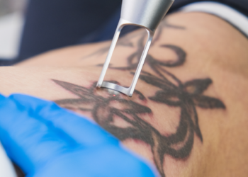 Tattoo Removal Explained for First-Time Clients