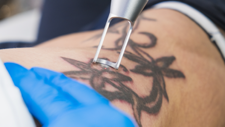 Tattoo Removal Explained for First-Time Clients