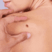 Understanding Skin Cancer Related Lumps and Bumps